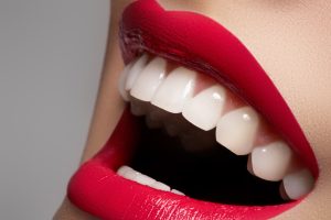 woman with dental veneers