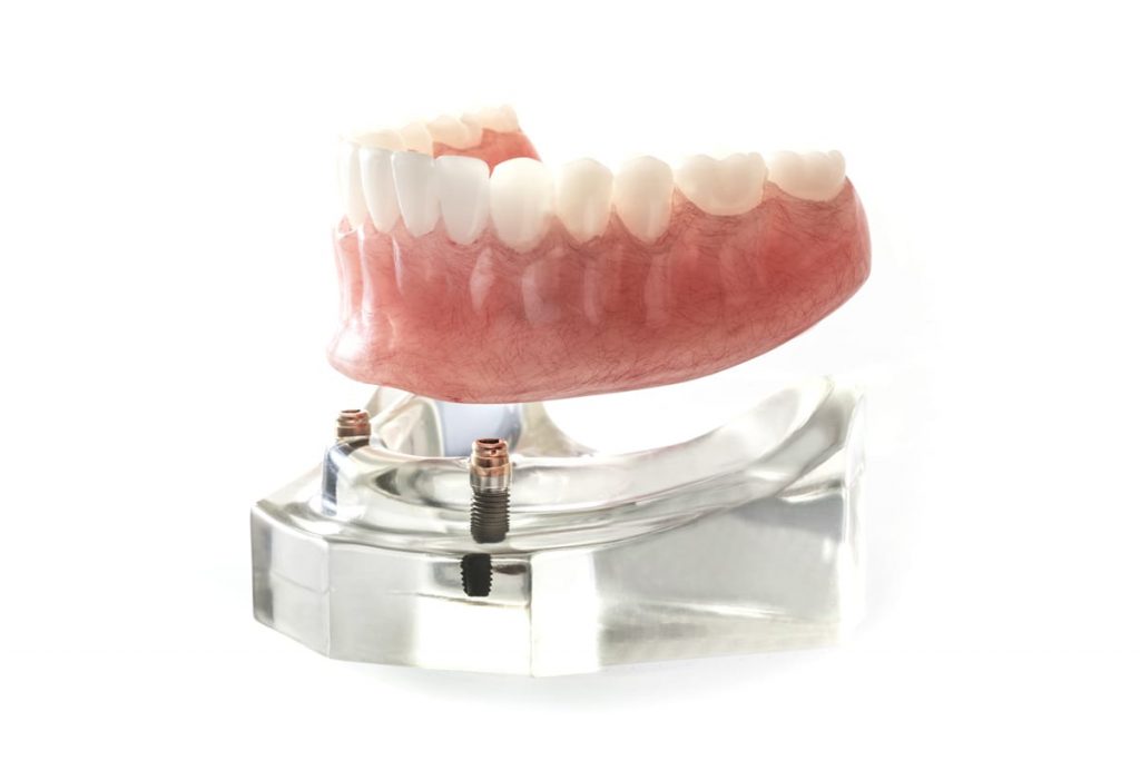 photo of dentures 