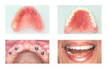 photos of various dentures