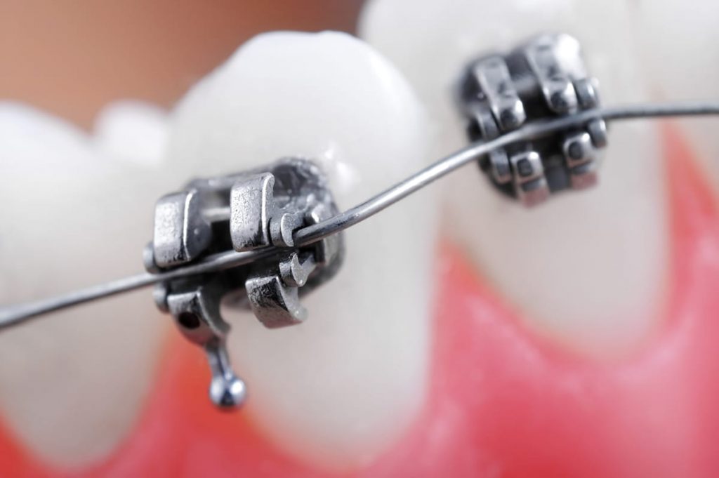 photo of dental braces