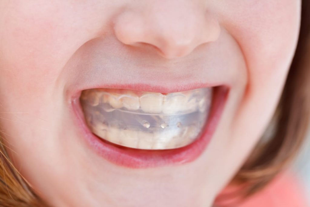 girl with mouth guard 