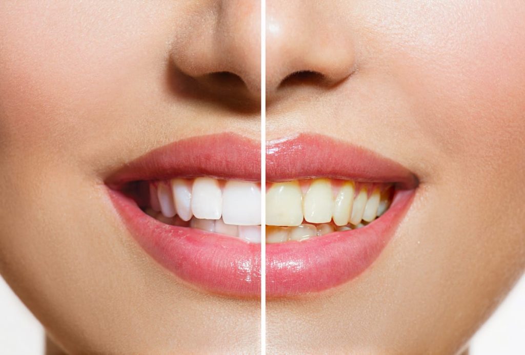 before and after of womans smile