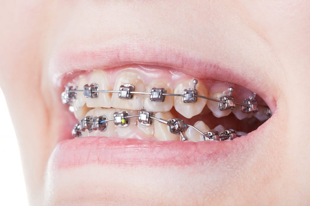 woman with metal braces