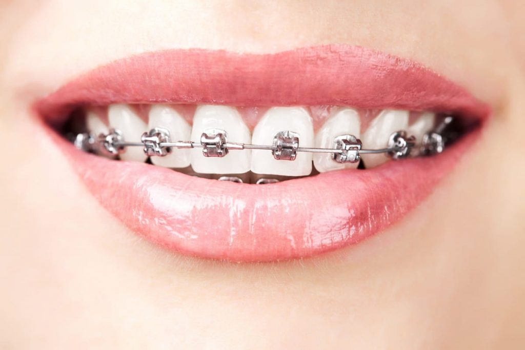 woman with metal braces