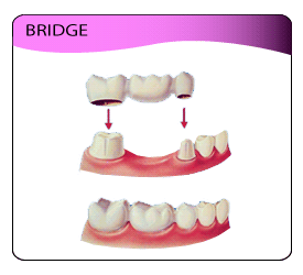 illustration of dental bridge