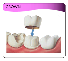 illustration of dental crown