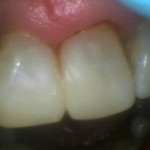 photo of results of tooth gap filling