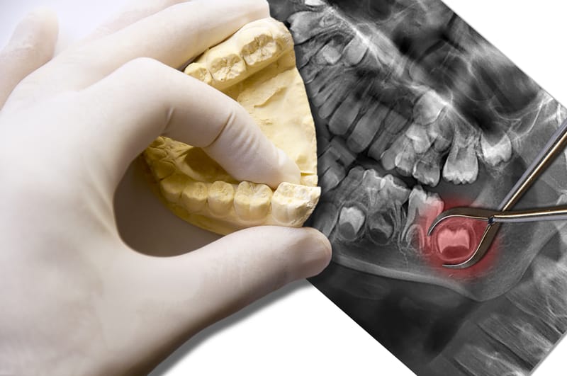 photo wisdom tooth model and xray