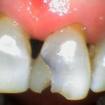 photo of tooth gap