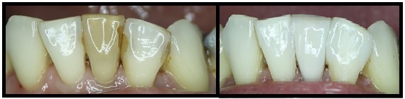 before and after photos of dental cleaning case3