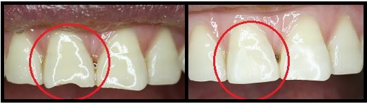 before and after photos of dental cleaning case1