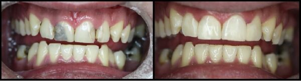 before and after photos of dental cleaning case2