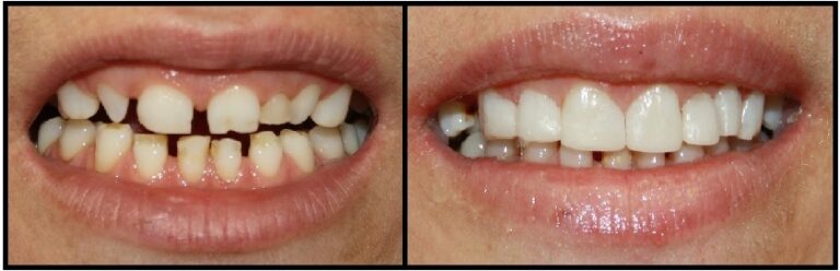 before and after dental veneers