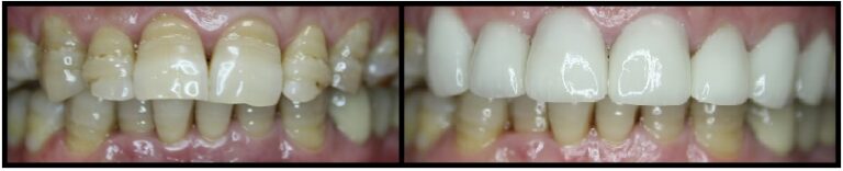 before and after dental veneers case 2