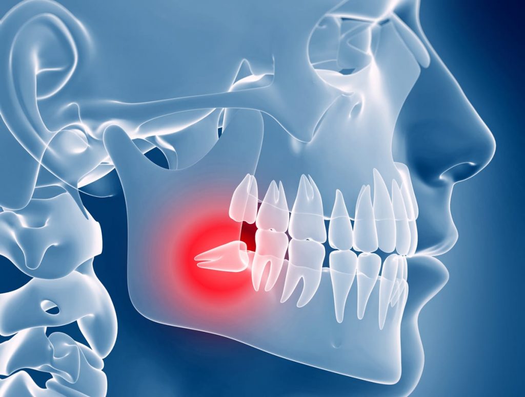 illustration of wisdom tooth in mouth