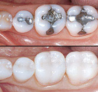 photo of white dental fillings