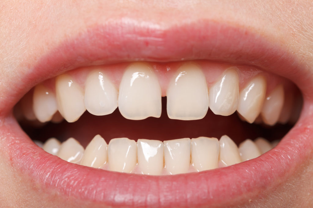 teeth with diastema